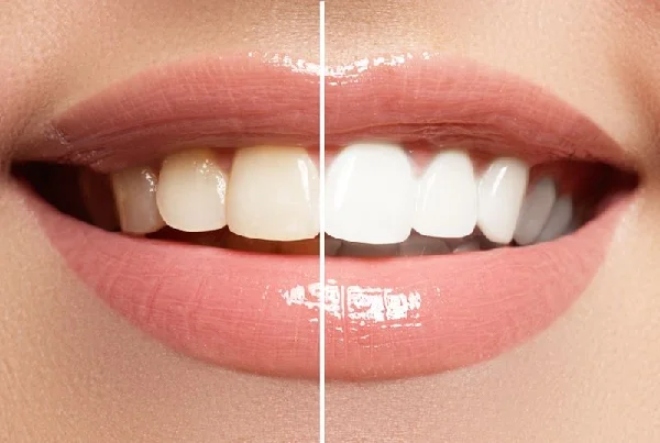 Cleaning and Bleaching