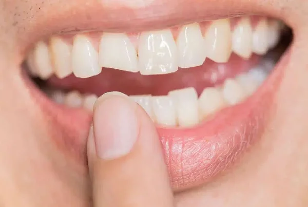 Treating Cracked Teeth