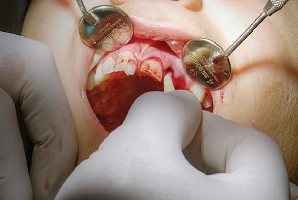 Treating Dental Trauma