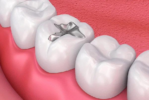 Dental Restorations