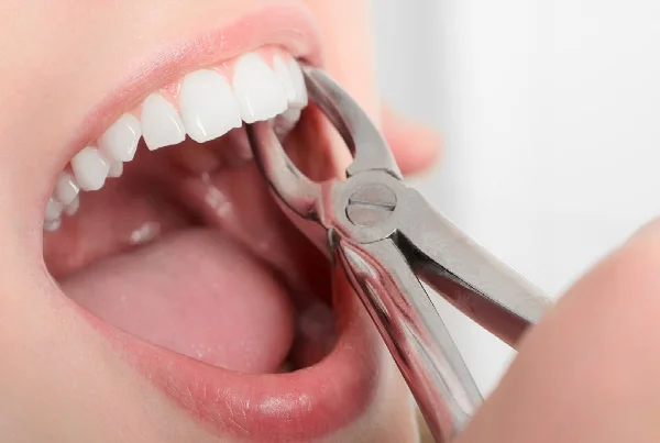 Extraction of Teeth